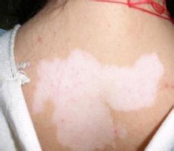 白癜风留意这几种药千万别用 白癜风留意这几种药千万别用.jpg